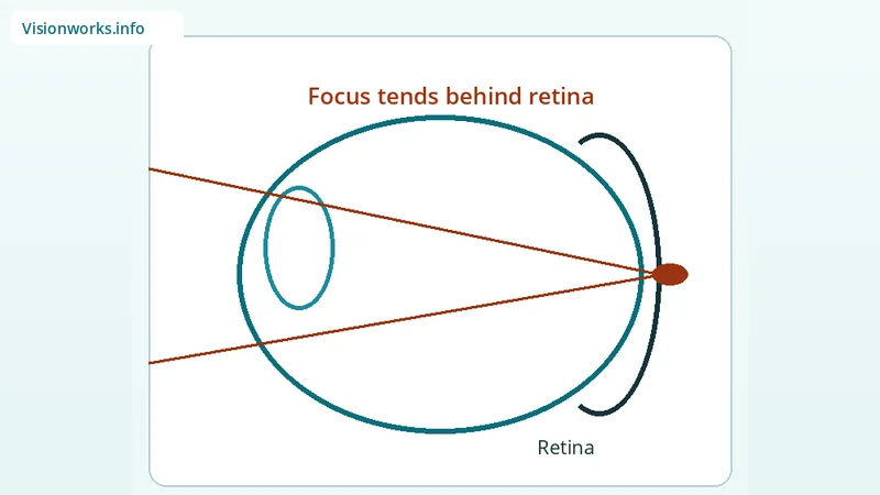 Simplified educational focusing diagram for Hyperopia (farsightedness)
