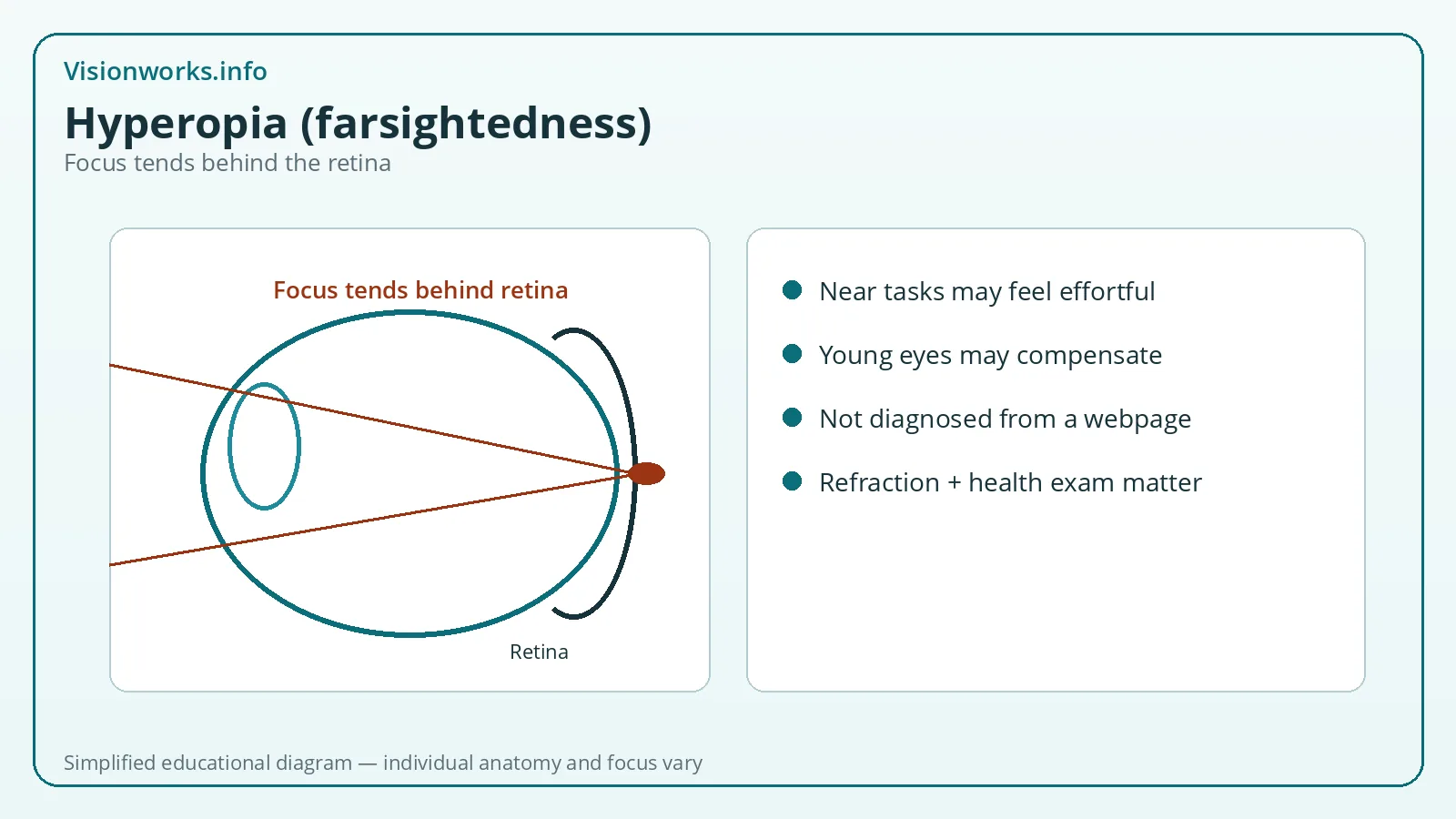 Simplified educational focusing diagram for Hyperopia (farsightedness)