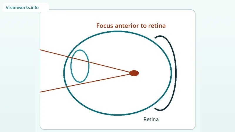 Simplified educational focusing diagram for Myopia (nearsightedness)